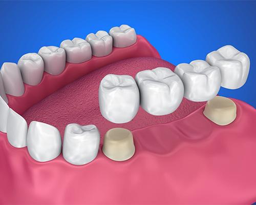 Dental Bridges & Crowns - Restore Your Smile