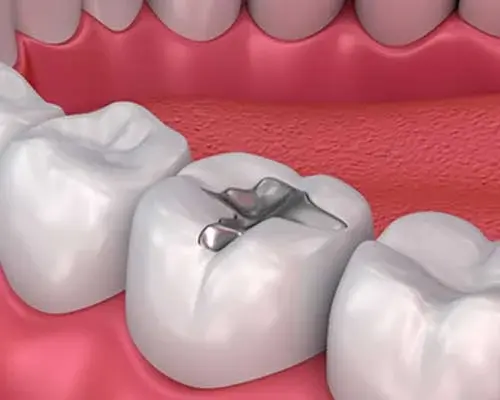 Dental Fillings