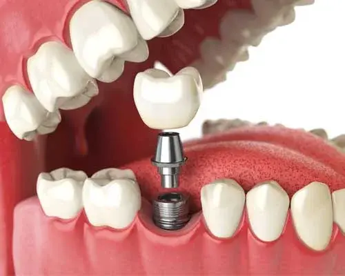 Dental Implants - Permanent Tooth Replacement