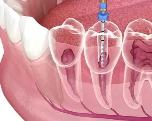 Root Canal Treatment